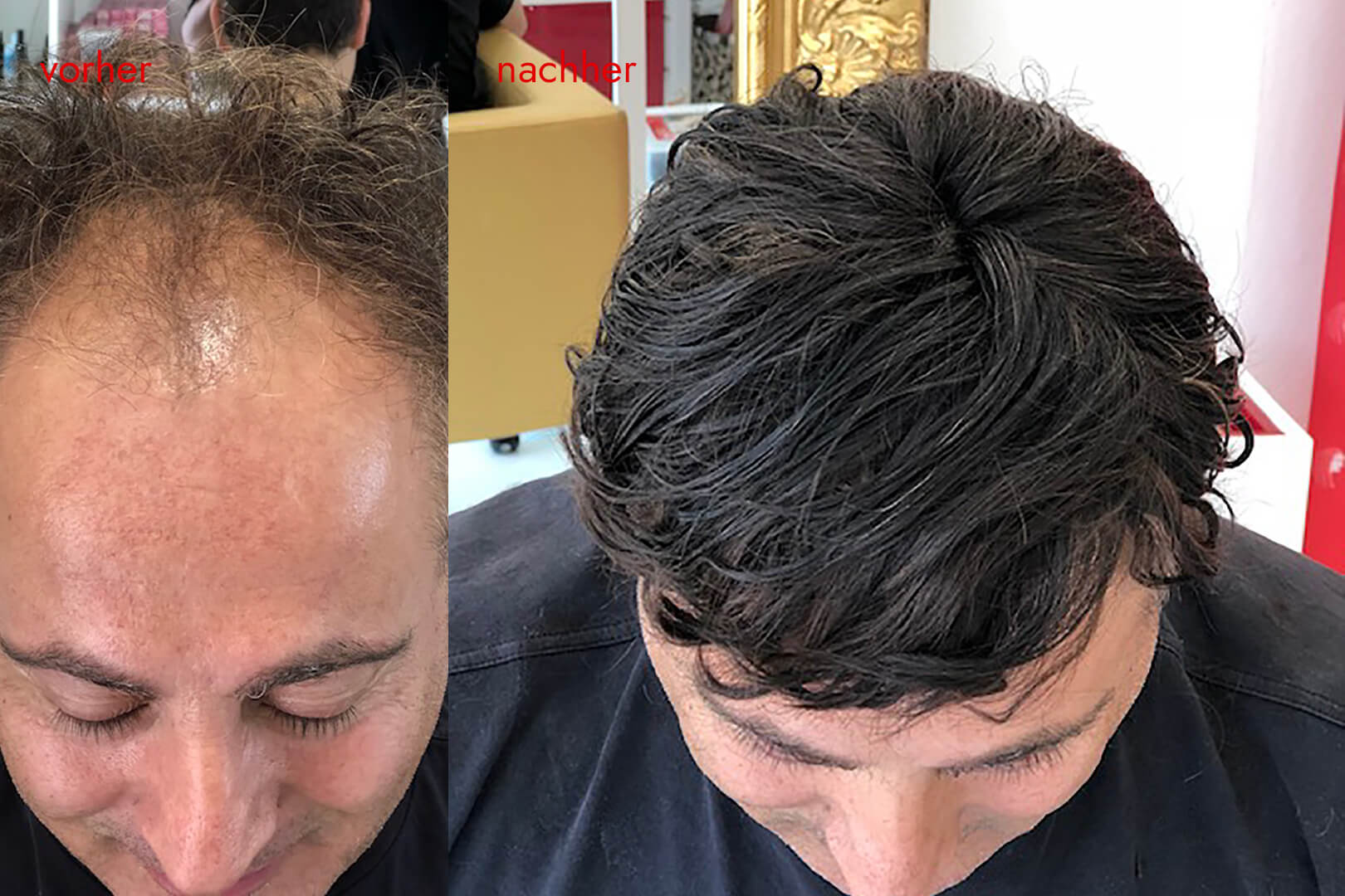 Angelicas Hair Extensions: Haarverdichtung bei krankheitsbedingtem Haarausfall von Männer - Kunde vorher und nachher